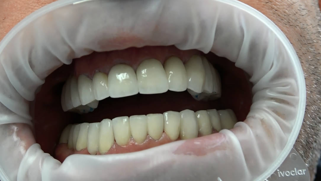 Implantologia fissa senza osso Protesi su impisnti in ceramica zirconio senza falsa gengiva 14 denti estetica naturale